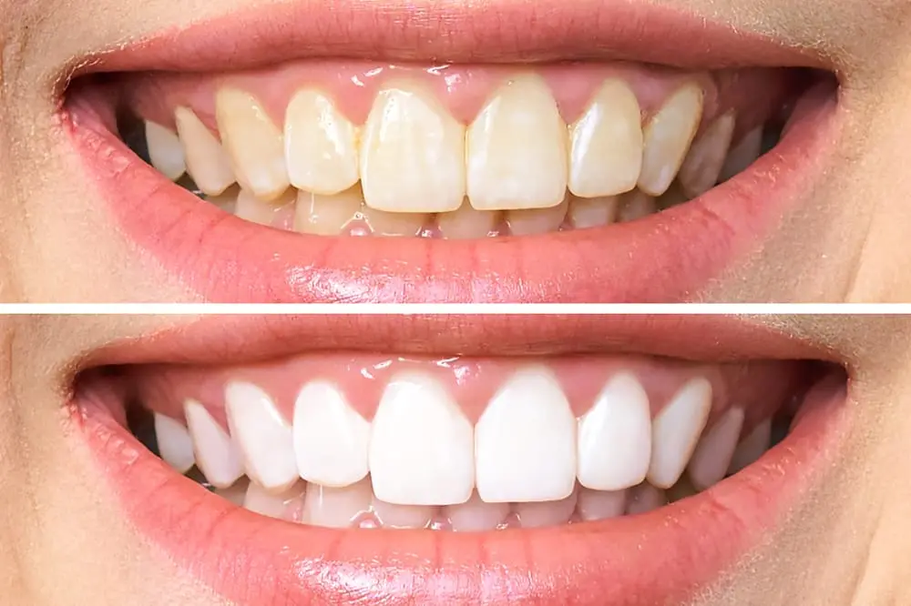 Teeth before and after Zoom whitening