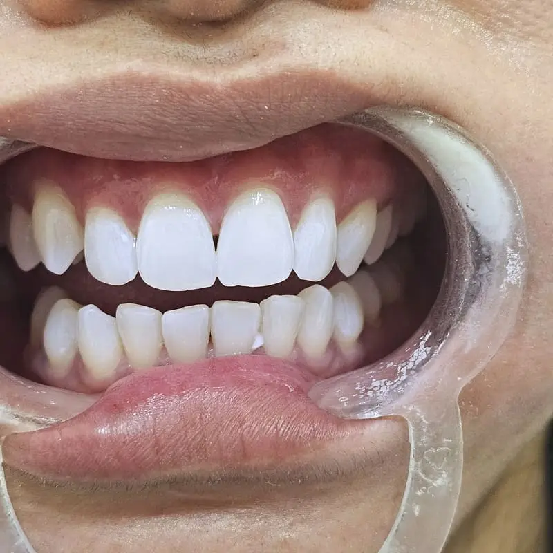 Zoom teeth whitening patient 1 - after