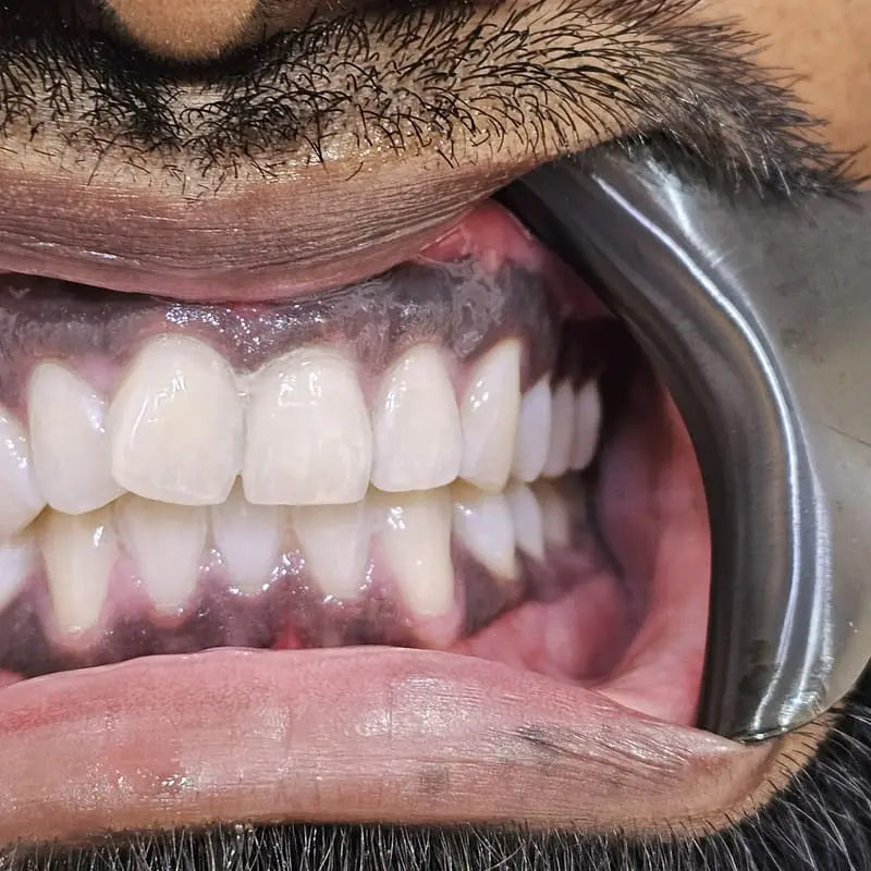 Zoom teeth whitening patient 2 - after