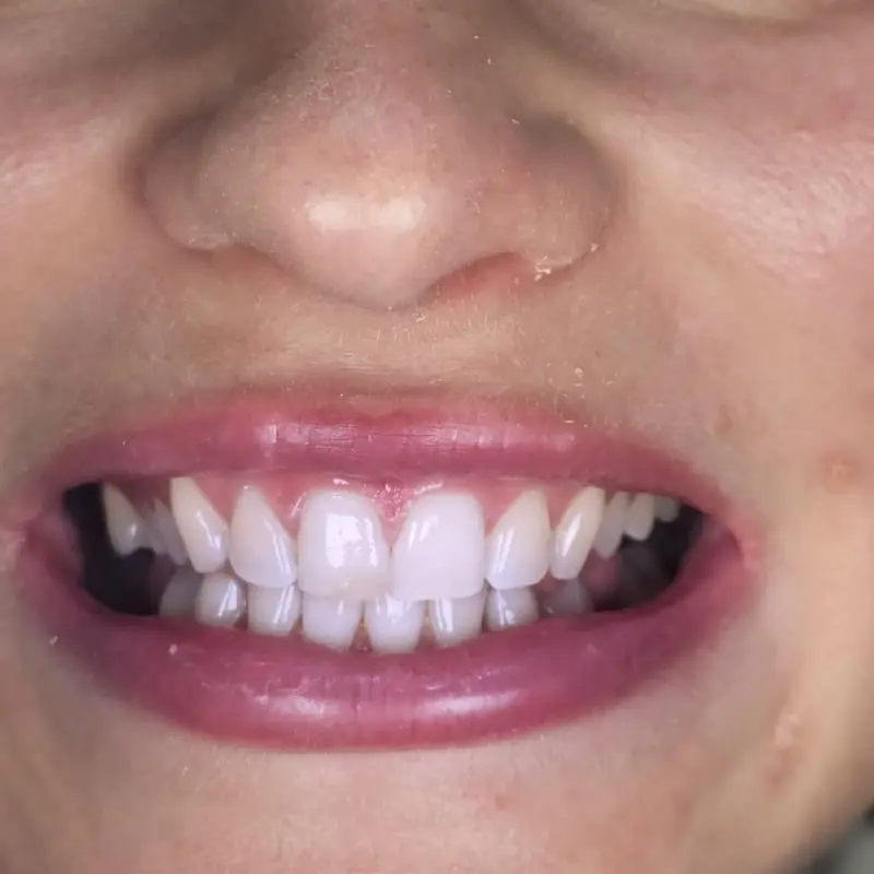 Zoom teeth whitening patient 3 - after