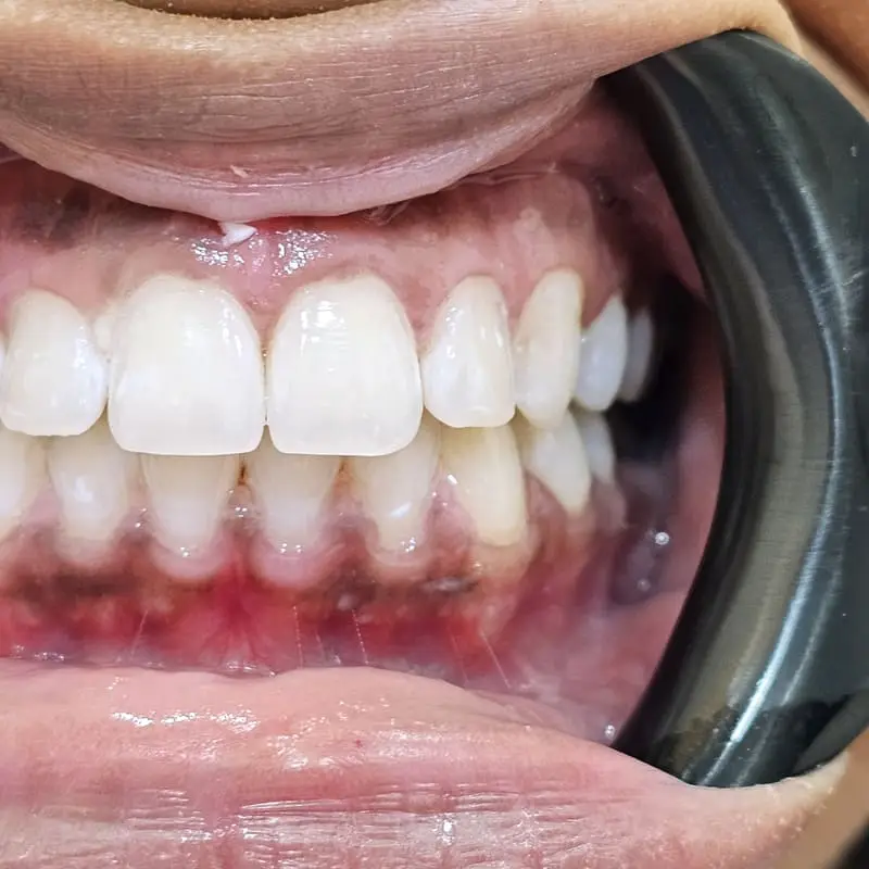 Zoom teeth whitening patient 4 - after