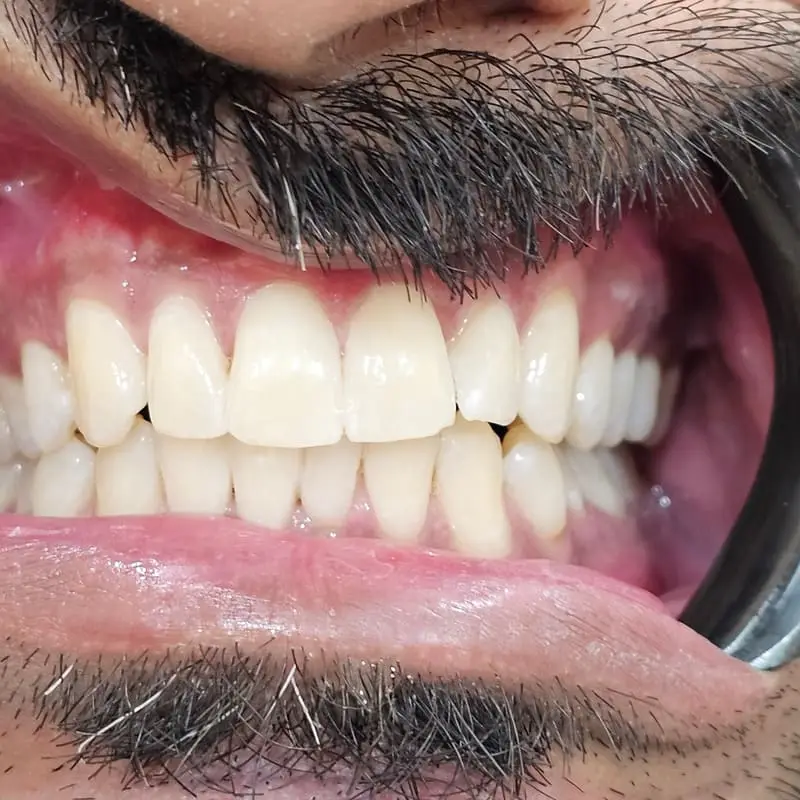 Zoom teeth whitening patient 5 - after
