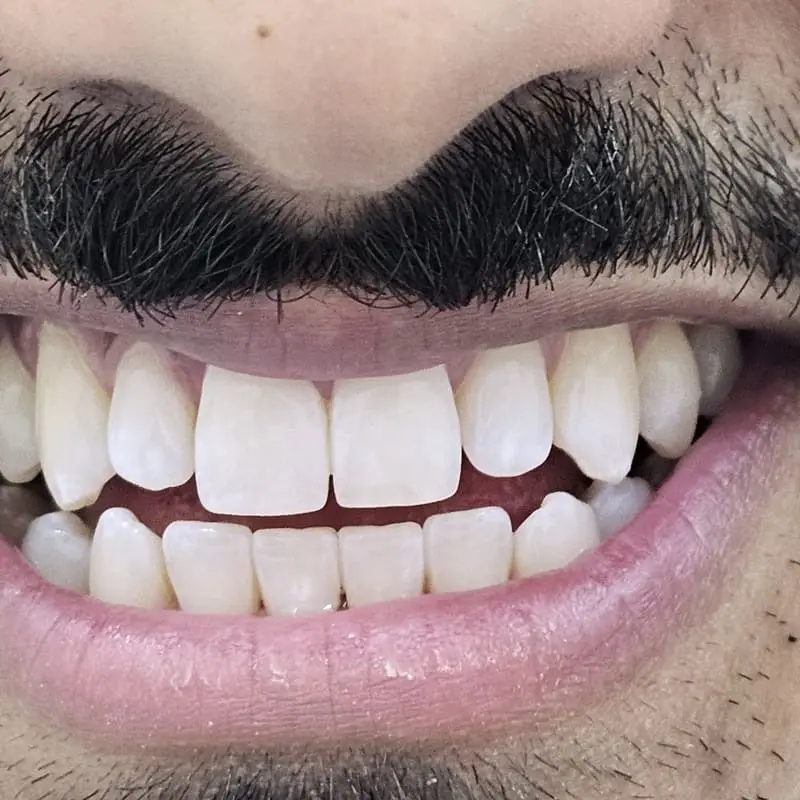 Zoom teeth whitening patient 6 - after