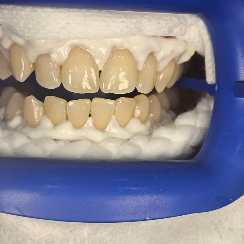 Zoom teeth whitening patient 1 - before