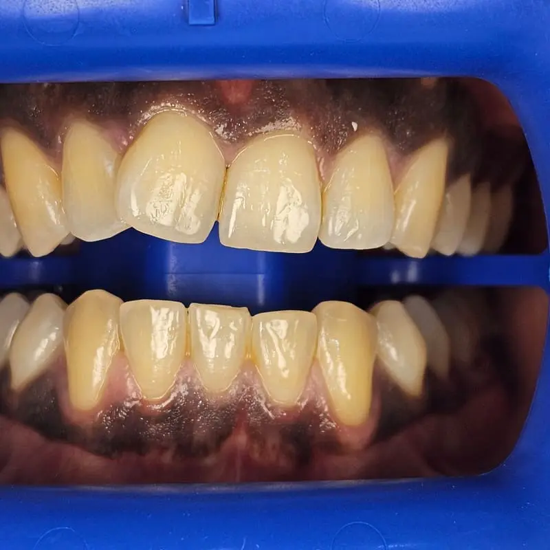 Zoom teeth whitening patient 2 - before