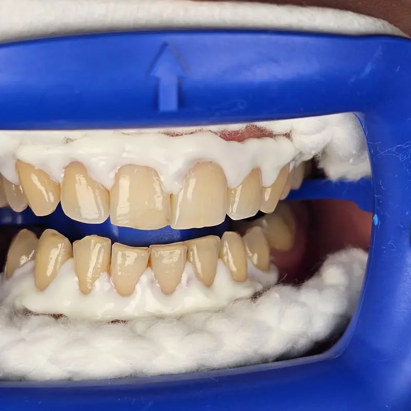 Zoom teeth whitening patient 3 - before