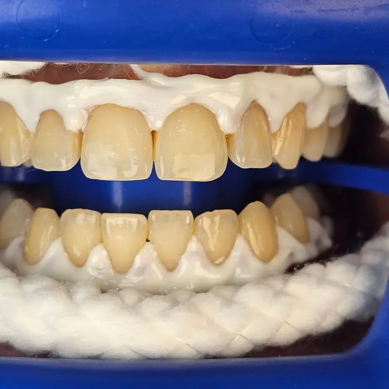 Zoom teeth whitening patient 4 - before