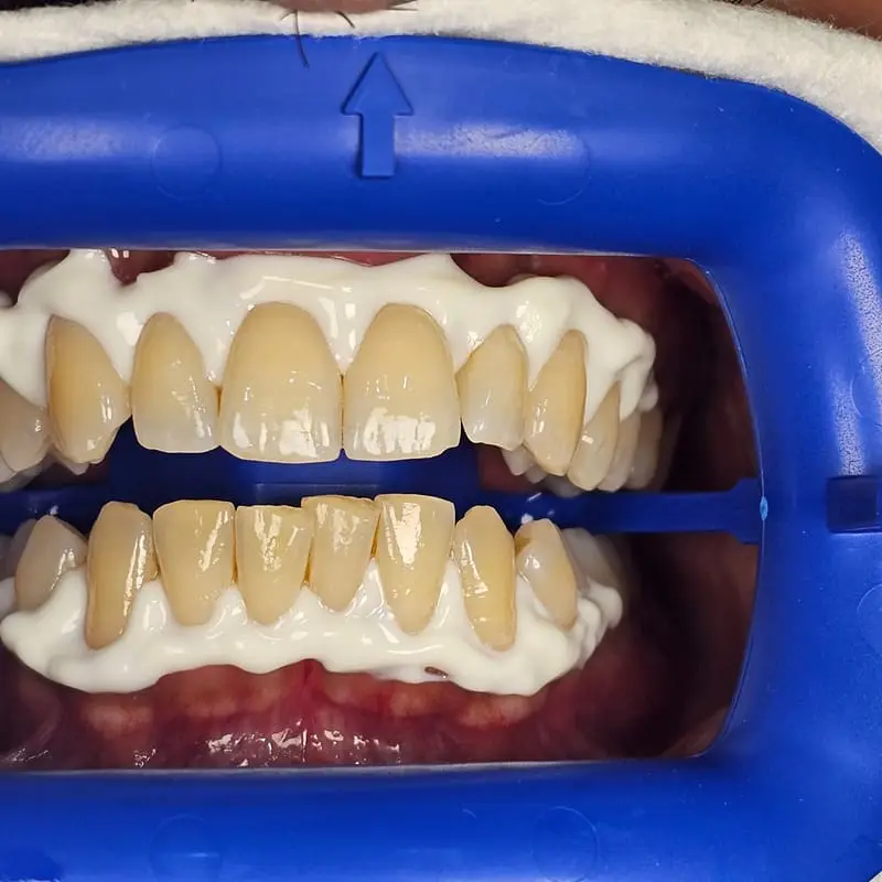 Zoom teeth whitening patient 5 - before