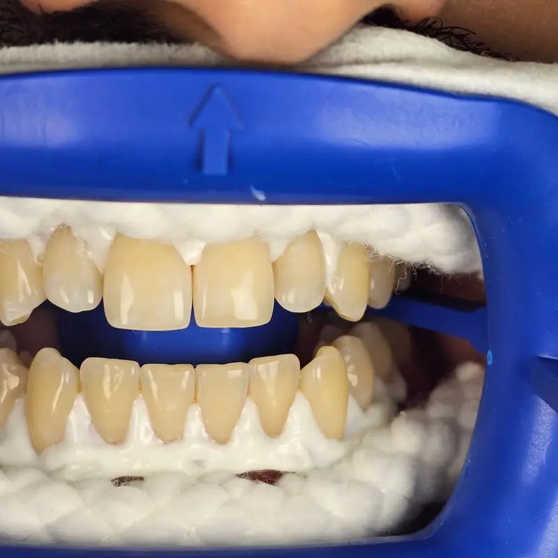 Zoom teeth whitening patient 6 - before